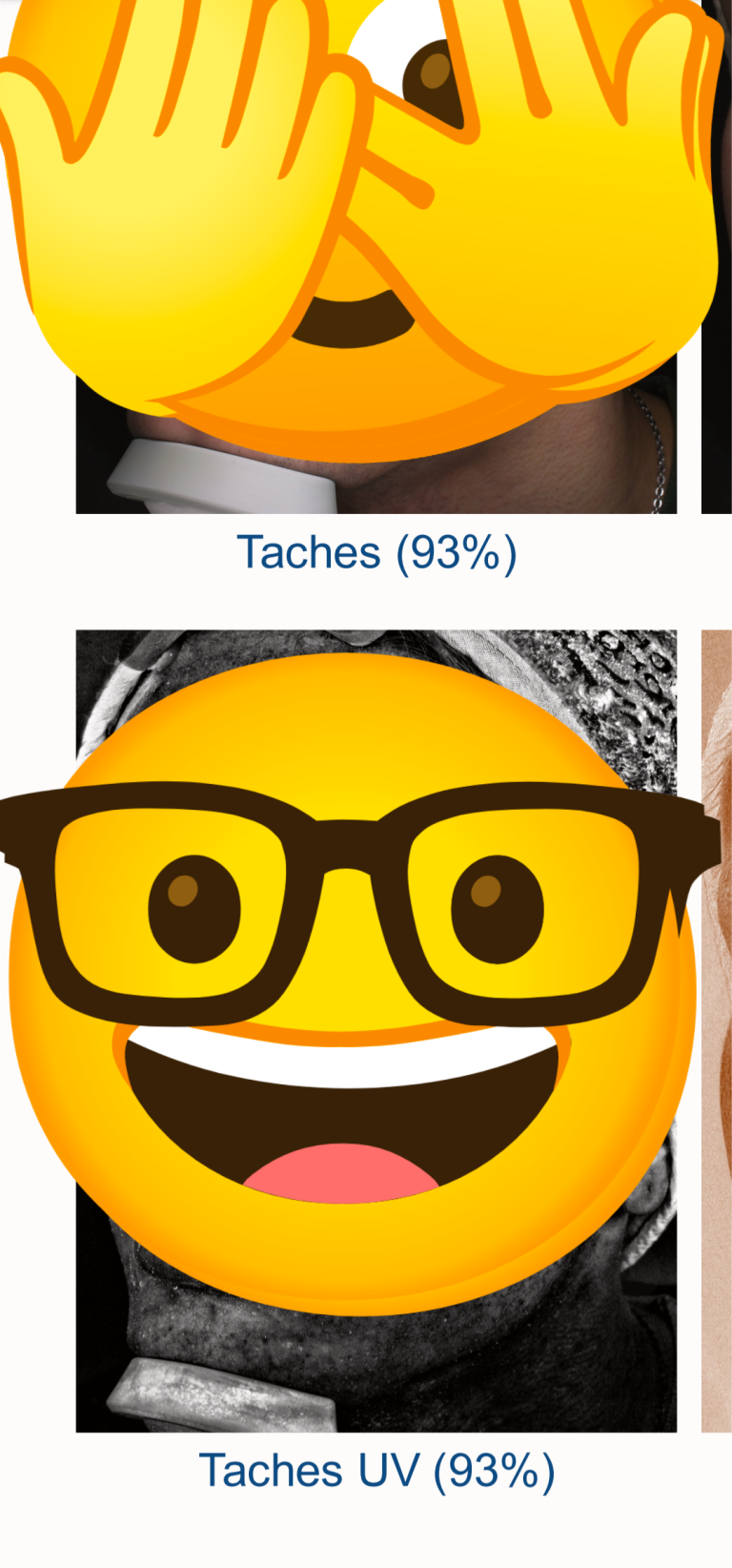Résultat analyse Visia côté droit montrant 93% de capital solaire préservé